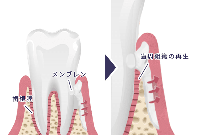GTR（歯周組織誘導法）