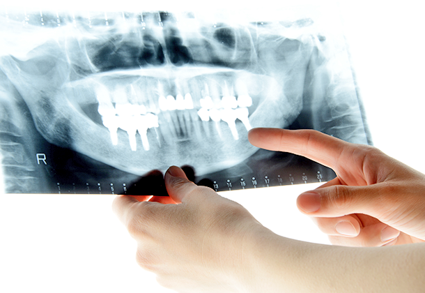 歯科用CTによる精密な検査と的確な診断